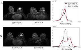 Luminal A and B breast MRI comparison