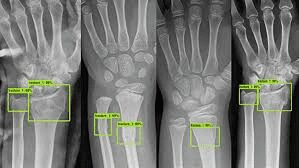 Multiple wrist X-rays with green annotation boxes