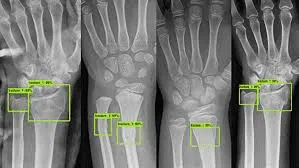 Multiple wrist X-rays with green annotation boxes