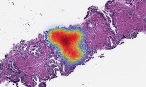 Histology tissue slide with colored heatmap overlay