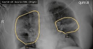 Bilateral lung opacities on chest X-ray