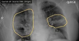 Bilateral lung opacities on chest X-ray