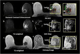 Composite breast MRI images highlighting lesion