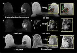 Composite breast MRI images highlighting lesion