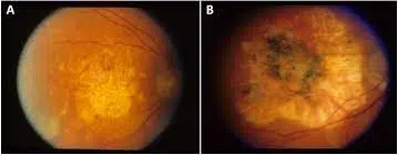 Fundus photographs showing macular lesions