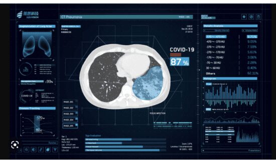 CT chest scan showing COVID-19 lung damage