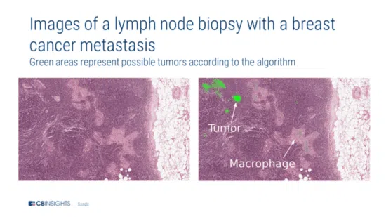 Lymph node biopsy images showing breast cancer metastasis