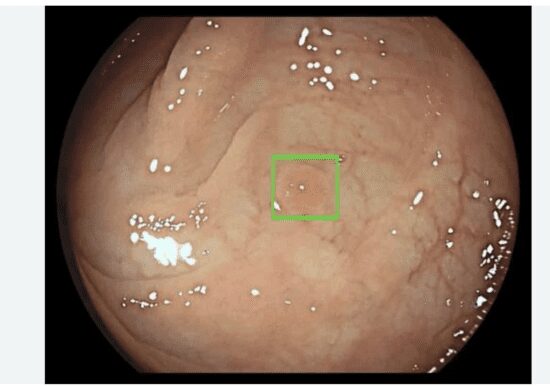 Endoscopic mucosa image with small highlighted lesion