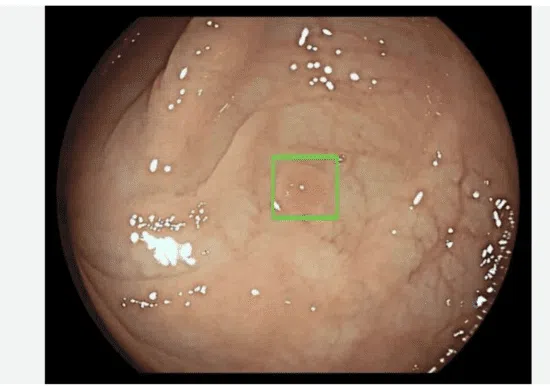 Endoscopic mucosa image with small highlighted lesion